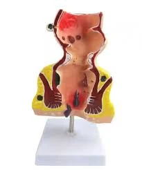 Rectum Pathologies Model