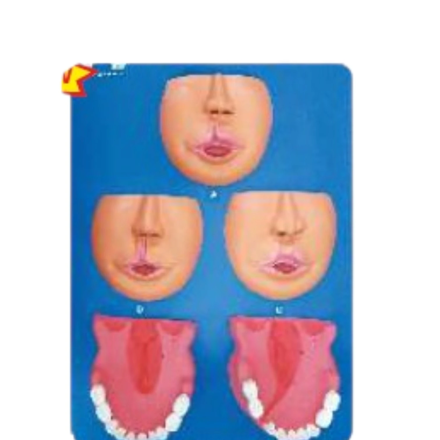 Cleft Lip & Palate