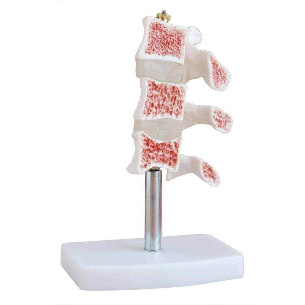 XC-134 Cutaway Osteoporosis