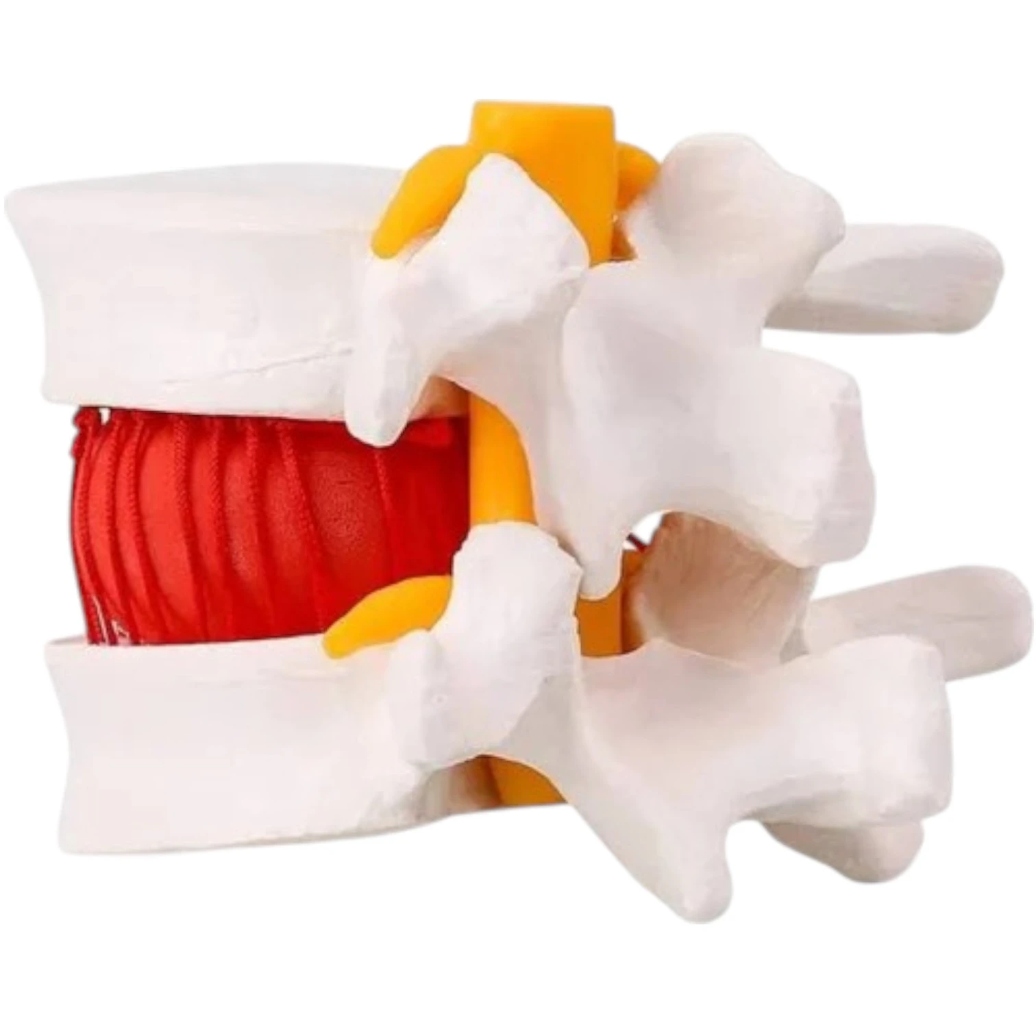 ZX-1504 Functioning Prolapsed Lumbar Vertebrae Model (Slipped Disc)