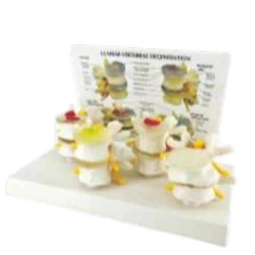 Lumbar Vertebrae Degeneration Model