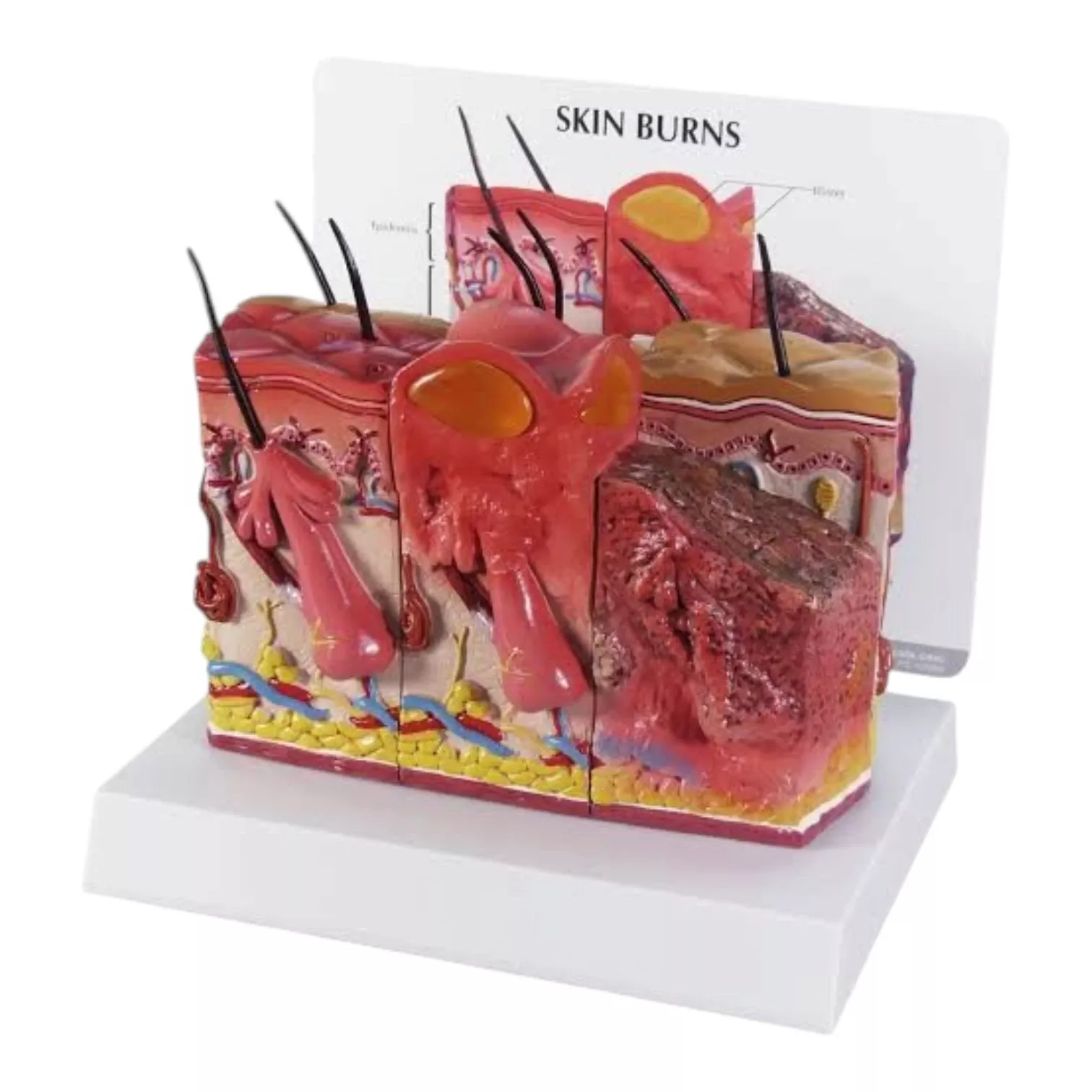 Skin Burn Anatomy Model (75X Enlarged) for Medical & Nursing Education