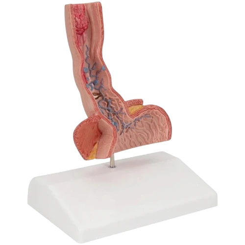 Diseases of Esophagus